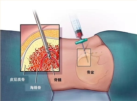 穿刺針沖壓廠(chǎng)家